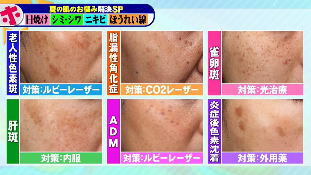 シミの種類と対策法